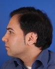 After Hair Transplant&nbsp;Front
